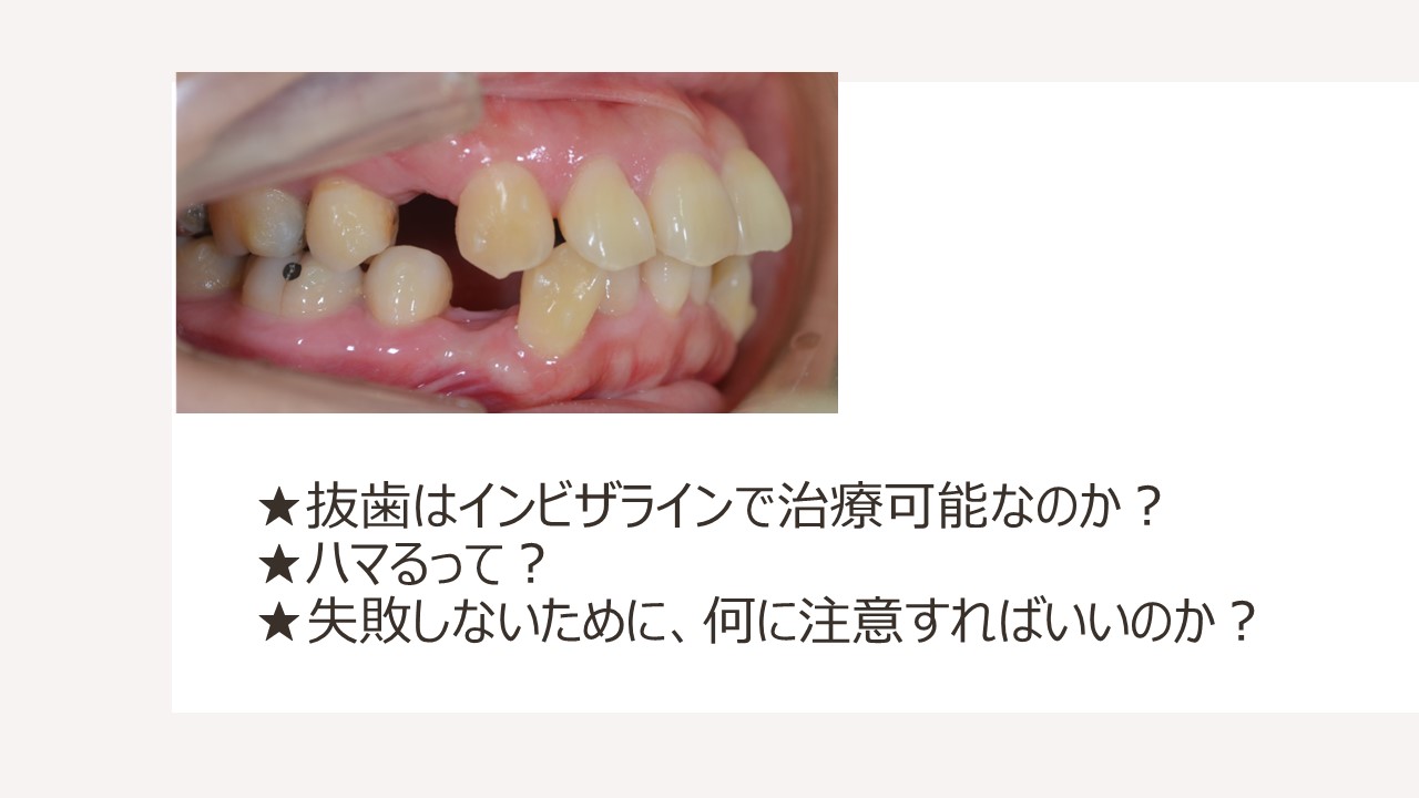 インビザライン抜歯の治療